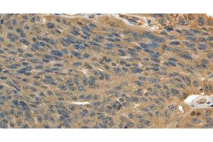 Immunohistochemistry of paraffin-embedded Human ovarian cancer using MSN Polyclonal Antibody at dilution of 1:30