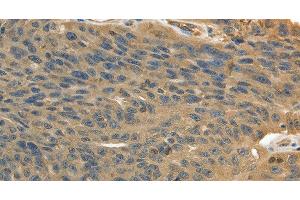 Immunohistochemistry of paraffin-embedded Human ovarian cancer using MSN Polyclonal Antibody at dilution of 1:30 (Moesin anticorps)
