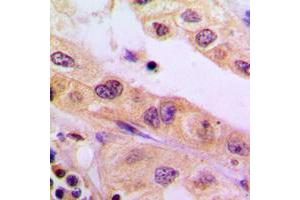 Immunohistochemical analysis of CYB5R3 staining in human liver cancer formalin fixed paraffin embedded tissue section.