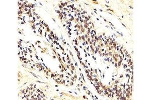 IHC analysis of FFPE human prostate carcinoma section using AKT1/2/3 antibody; Ab was diluted at 1:25. (AKT 1/2/3 anticorps  (AA 278-312))