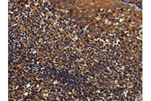 The image on the left is immunohistochemistry of paraffin-embedded Human tonsil tissue using ABIN7129963(KCNK17 Antibody) at dilution 1/60, on the right is treated with fusion protein. (KCNK17 anticorps)