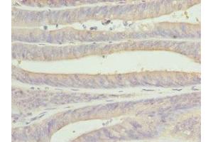 Immunohistochemistry of paraffin-embedded human endometrial cancer using ABIN7146874 at dilution of 1:100