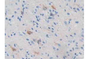 IHC-P analysis of Human Glioma Tissue, with DAB staining.