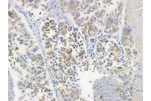 ABIN6260320 and ABIN6272259 at 1/100 staining human lung squamous cell carcinoma by IHC-P. (BTBD6 anticorps  (Internal Region))