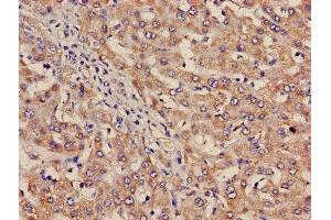 Immunohistochemistry of paraffin-embedded human liver cancer using ABIN7156456 at dilution of 1:100 (Integrin Alpha2b anticorps  (AA 639-887))