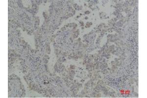 Immunohistochemistry (IHC) analysis of paraffin-embedded Human Lung Carcinoma using Bcl-XlRabbit Polyclonal Antibody diluted at 1:200. (BCL2L1 anticorps)