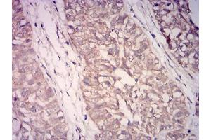 Immunohistochemical analysis of paraffin-embedded bladder cancer tissues using WDFY3 mouse mAb with DAB staining. (WDFY3 anticorps  (AA 3277-3526))