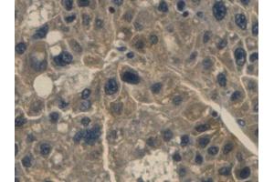 Detection of Hpt in Human Liver cancer Tissue using Monoclonal Antibody to Haptoglobin (Hpt)