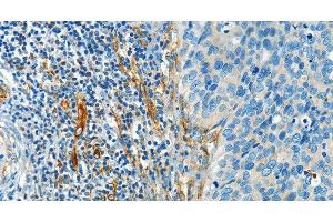 Immunohistochemistry of paraffin-embedded Human cervical cancer tissue using DIO2 Polyclonal Antibody at dilution 1:50 (DIO2 anticorps)