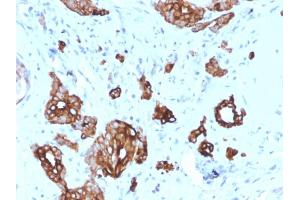 Formalin-fixed, paraffin-embedded human Breast Carcinoma stained with Cytokeratin-7 Mouse Monoclonal Antibody (KRT7/2200). (Cytokeratin 7 anticorps)