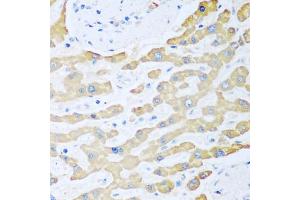 Immunohistochemistry of paraffin-embedded human liver cancer using FDXR antibody. (Ferredoxin Reductase anticorps)