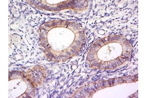 Paraformaldehyde-fixed, paraffin embedded human cervical cancer, Antigen retrieval by boiling in sodium citrate buffer (pH6) for 15min, Block endogenous peroxidase by 3% hydrogen peroxide for 30 minutes, Blocking buffer (normal goat serum) at 37°C for 20min, Antibody incubation with Rabbit Anti-PLEKHA7 Polyclonal Antibody, Unconjugated  at 1:200 overnight at 4°C, followed by a conjugated secondary for 90 minutes and DAB staining.