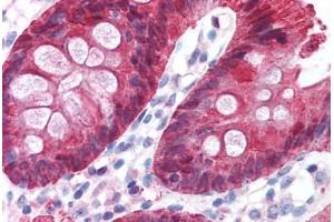 Human Colon (formalin-fixed, paraffin-embedded) stained with CA2 antibody ABIN214579 at 5 ug/ml followed by biotinylated goat anti-rabbit IgG secondary antibody ABIN481713, alkaline phosphatase-streptavidin and chromogen. (CA2 anticorps)