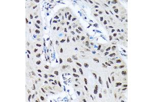 Immunohistochemistry of paraffin-embedded human lung cancer using SMN1 Rabbit mAb (ABIN7270651) at dilution of 1:100 (40x lens). (SMN1 anticorps)