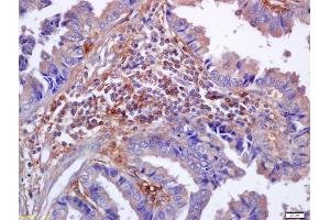 Formalin-fixed and paraffin embedded human lung carcinoma labeled with Anti-phospho-Nrf2 (Ser40) Polyclonal Antibody, Unconjugated (ABIN676673) at 1:200 followed by conjugation to the secondary antibody and DAB staining