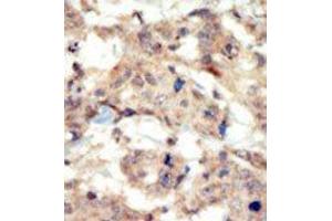 Formalin-fixed and paraffin-embedded human cancer tissue reacted with the primary antibody, which was peroxidase-conjugated to the secondary antibody, followed by DAB staining.