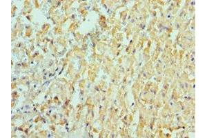 Immunohistochemistry of paraffin-embedded human liver cancer using ABIN7150066 at dilution of 1:100 (ADAM9 anticorps  (AA 475-685))