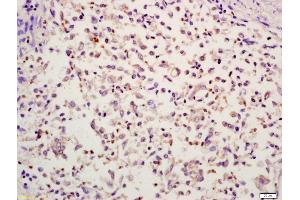 Formalin-fixed and paraffin embedded human colon carcinoma labeled with Anti-HMGB4 Polyclonal Antibody, Unconjugated (ABIN734918) at 1:200 followed by conjugation to the secondary antibody and DAB stainin (HMGB4 anticorps  (AA 31-130))
