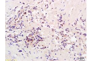 Formalin-fixed and paraffin embedded human colon carcinoma labeled with Rabbit Anti AADAC Polyclonal Antibody, Unconjugated (ABIN1387867) at 1:200 followed by conjugation to the secondary antibody and DAB staining (AADAC anticorps  (AA 228-273))