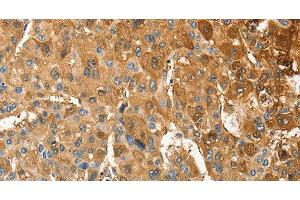 Immunohistochemistry of paraffin-embedded Human liver cancer tissue using ANXA9 Polyclonal Antibody at dilution 1:30 (Annexin A9 anticorps)