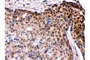 Anti- IRF5 Picoband antibody, IHC(P) IHC(P): Human Mammary Cancer Tissue