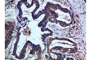 Immunohistochemical analysis of paraffin-embedded Human-colon-cancer, antibody was diluted at 1:100