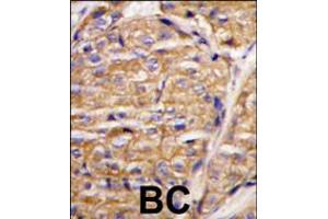 Formalin-fixed and paraffin-embedded human breast carcinoma tissue reacted with MIPEP antibody , which was peroxidase-conjugated to the secondary antibody, followed by DAB staining.