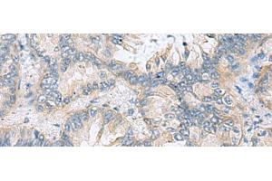 Immunohistochemistry of paraffin-embedded Human lung cancer tissue using TAGLN3 Polyclonal Antibody at dilution of 1:70(x200) (Transgelin 3 anticorps)