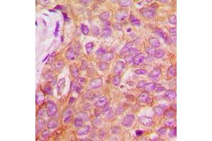 Immunohistochemical analysis of IRS1 (pS1101) staining in human breast cancer formalin fixed paraffin embedded tissue section.