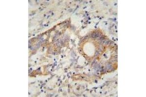 Immunohistochemistry analysis in formalin fixed and paraffin embedded human colon carcinoma reacted with AP52042PU-N, which was peroxidase conjugated to the secondary antibody and followed by DAB staining.