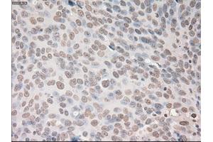 Immunohistochemical staining of paraffin-embedded Adenocarcinoma of breast tissue using anti-VEGF mouse monoclonal antibody. (VEGF anticorps  (AA 27-233))
