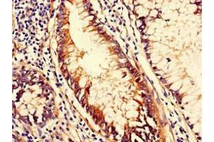 Immunohistochemistry of paraffin-embedded human colon cancer using ABIN7147114 at dilution of 1:100 (CD151 anticorps  (AA 125-199))