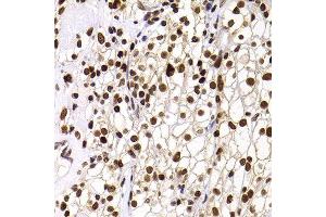 Immunohistochemistry of paraffin-embedded human well-differentiated squamous skin carcinoma using PHIP antibody at dilution of 1:100 (40x lens). (PHIP anticorps)