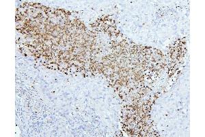 IHC analysis of CEACAM5 using anti-CEACAM5 antibody (ABIN7601435). (CEACAM5 anticorps  (AA 35-650))