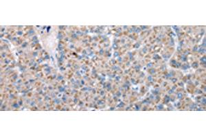 Immunohistochemistry of paraffin-embedded Human liver cancer tissue using FKBPL Polyclonal Antibody at dilution of 1:50(x200) (FKBPL anticorps)