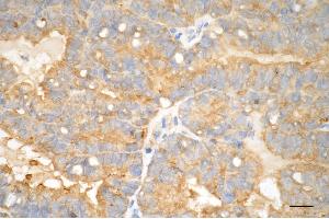 Immunohistochemistry was performed on paraffin-embedded human endometrial carcinoma using glutathione peroxidase 4 antibody (ABIN7798753), 1:200). (Recombinant GPX4 anticorps)