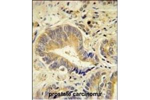 IDUA Antibody (Center) (ABIN651536 and ABIN2840285) immunohistochemistry analysis in formalin fixed and paraffin embedded human prostate carcinoma followed by peroxidase conjugation of the secondary antibody and DAB staining.
