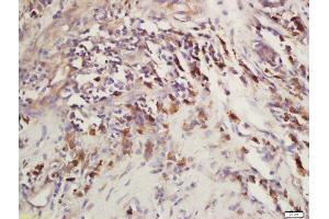 Formalin-fixed and paraffin embedded human laryngeal carcinoma labeled with Rabbit Anti-CEP120 Polyclonal Antibody, Unconjugated (ABIN2172950) at 1:200 followed by conjugation to the secondary antibody and DAB staining (CEP120 anticorps  (AA 351-450))