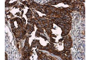 IHC-P Image VCAM1 / CD106 antibody detects VCAM1 / CD106 protein at cell membrane in human cervical carcinoma by immunohistochemical analysis. (VCAM1 anticorps)