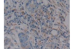 Detection of GPX1 in Human Breast cancer Tissue using Polyclonal Antibody to Glutathione Peroxidase 1 (GPX1)