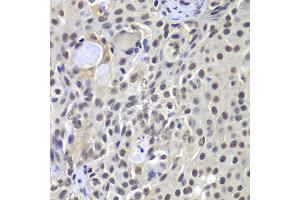 Immunohistochemistry of paraffin-embedded human well-differentiated squamous skin carcinoma using PRKDC antibody (ABIN5975861) at dilution of 1/100 (40x lens). (PRKDC anticorps)