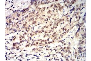 Immunohistochemical analysis of paraffin-embedded breast cancer tissues using ROP1 mouse mAb with DAB staining. (ROP1 (AA 42-183) anticorps)