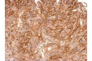 IHC-P Image ADAMTSL2 antibody [C3], C-term detects ADAMTSL2 protein at cytosol(secreted) on SkHep1xenograft by immunohistochemical analysis.
