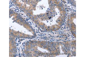 Immunohistochemistry of Human thyroid cancer using NPPB Polyclonal Antibody at dilution of 1:40 (NPPB anticorps)