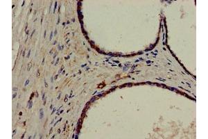 Immunohistochemistry of paraffin-embedded human prostate cancer using ABIN7150279 at dilution of 1:100