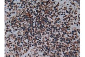 Detection of C2CD3 in Human Skin cancer Tissue using Polyclonal Antibody to C2 Calcium Dependent Domain Containing Protein 3 (C2CD3) (C2CD3 anticorps  (AA 1432-1647))