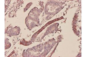 Immunoperoxidase of monoclonal antibody to SAA1 on formalin-fixed paraffin-embedded human colon adenocarcinoma tissue.