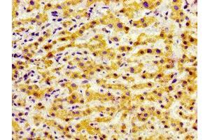 Immunohistochemistry of paraffin-embedded human liver cancer using ABIN7153297 at dilution of 1:100