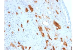 Formalin-fixed, paraffin-embedded human Mesothelioma stained with Calretinin Mouse Monoclonal Antibody (CALB2/2807). (Calretinin anticorps  (AA 23-242))