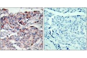 Immunohistochemistry analysis of paraffin-embedded human breast carcinoma, using JAK2 (Phospho-Tyr221) Antibody. (JAK2 anticorps  (pTyr221))